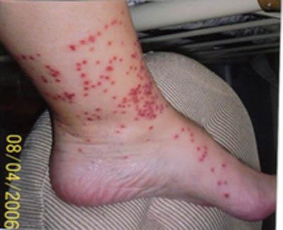 Flea Bite in Adults: Condition, Treatments, and Pictures ...